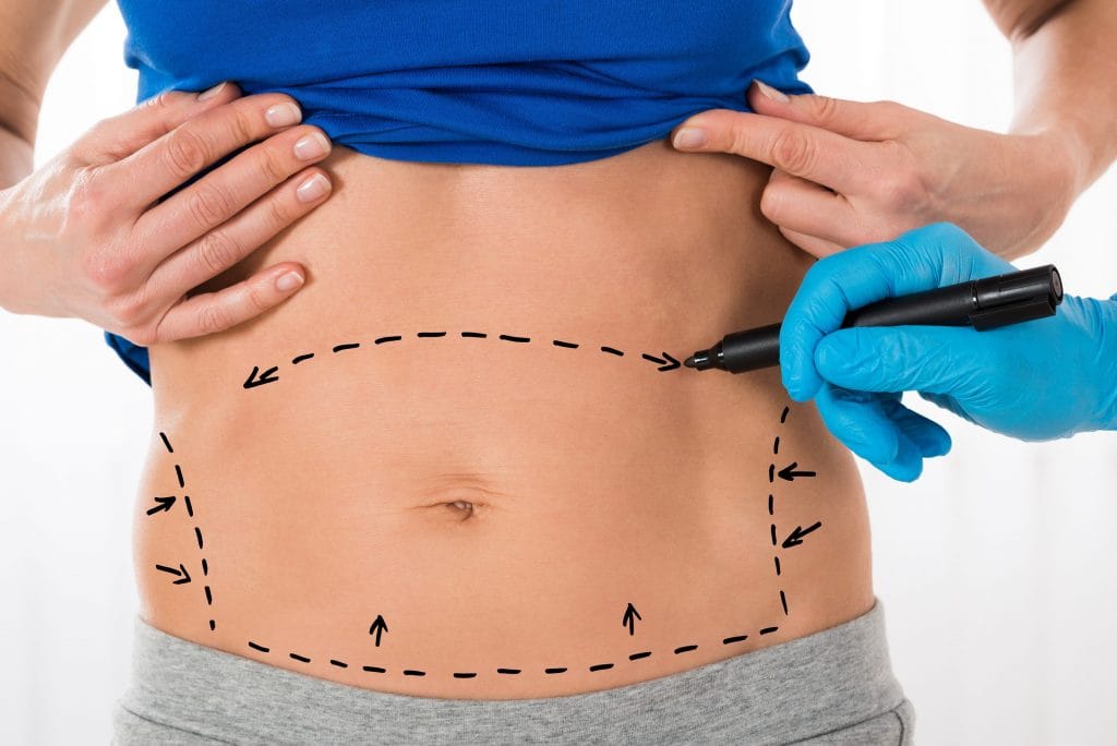 close up of woman's uncovered stomach with marker marks for tummy tuck incisions