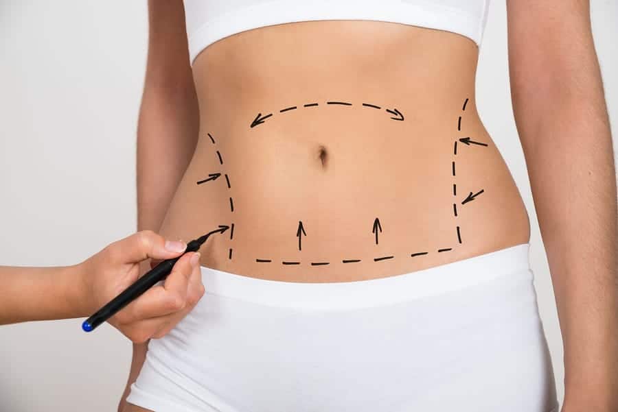 MPS Liposuction Miami FL