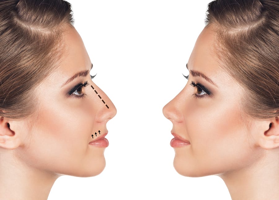 Nose Surgery Miami 1