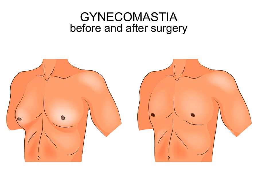 Male breast augmentation miami