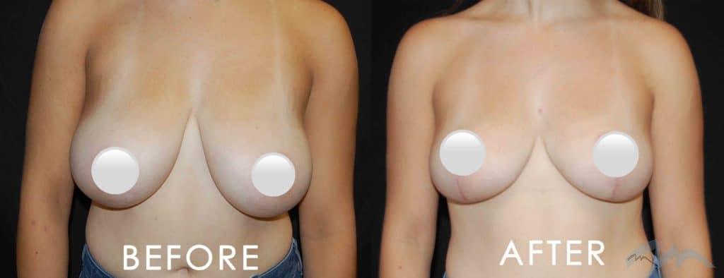 Breast Reduction 1024x394 1