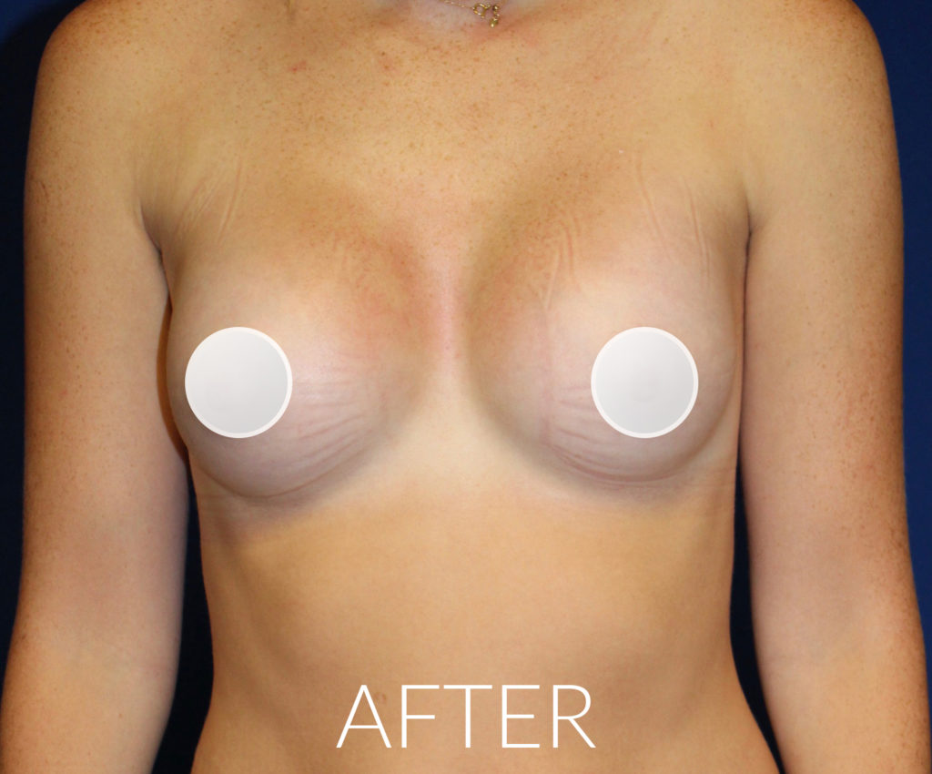 After Breast Augmentation Surgery