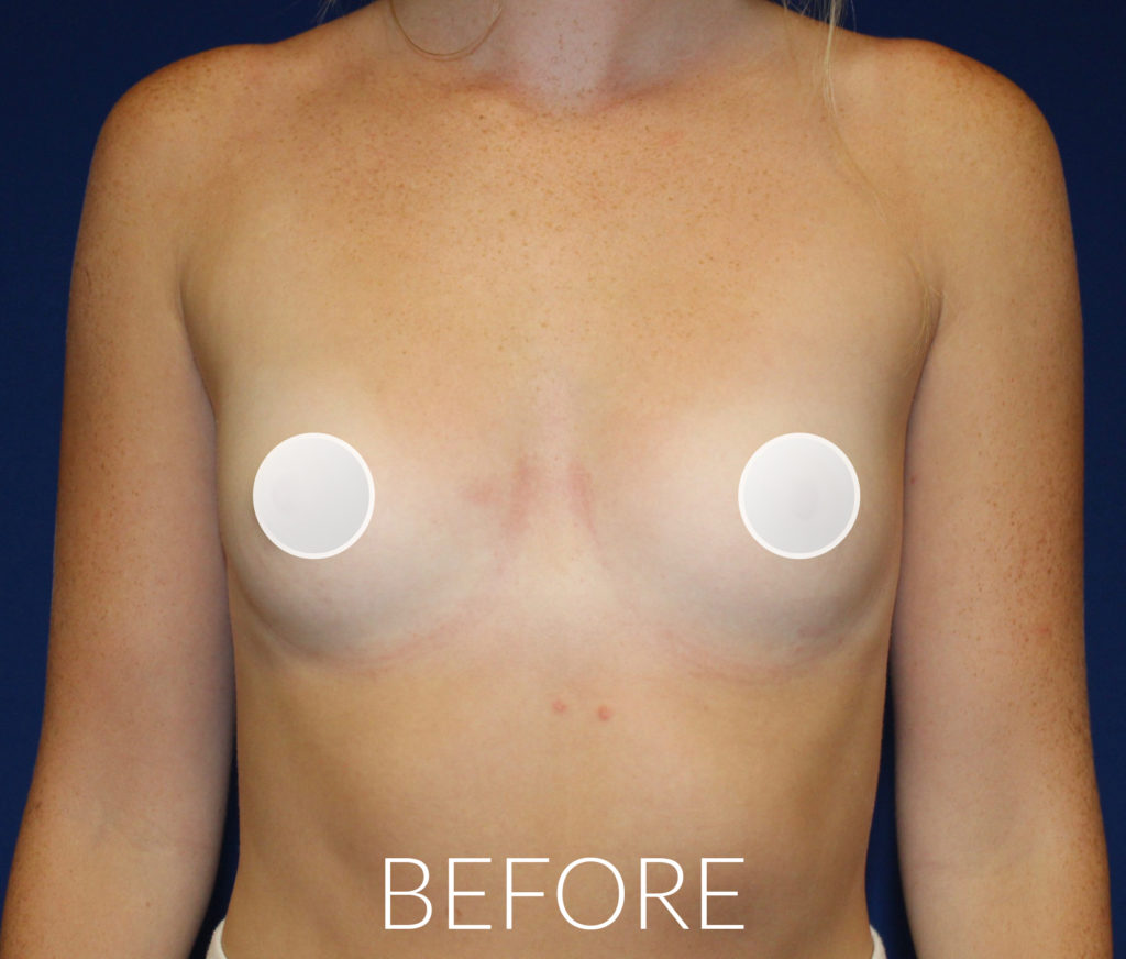 Before Breast Augmentation Surgery Before Breast Augmentation Surgery