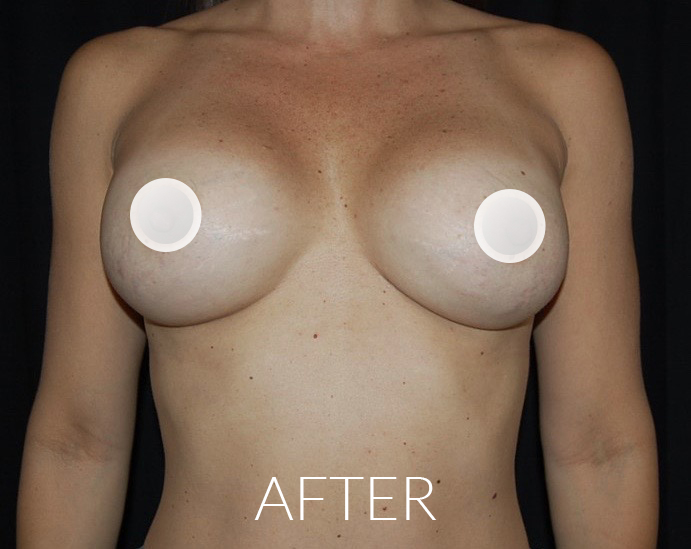 After Breast Augmentation Surgery