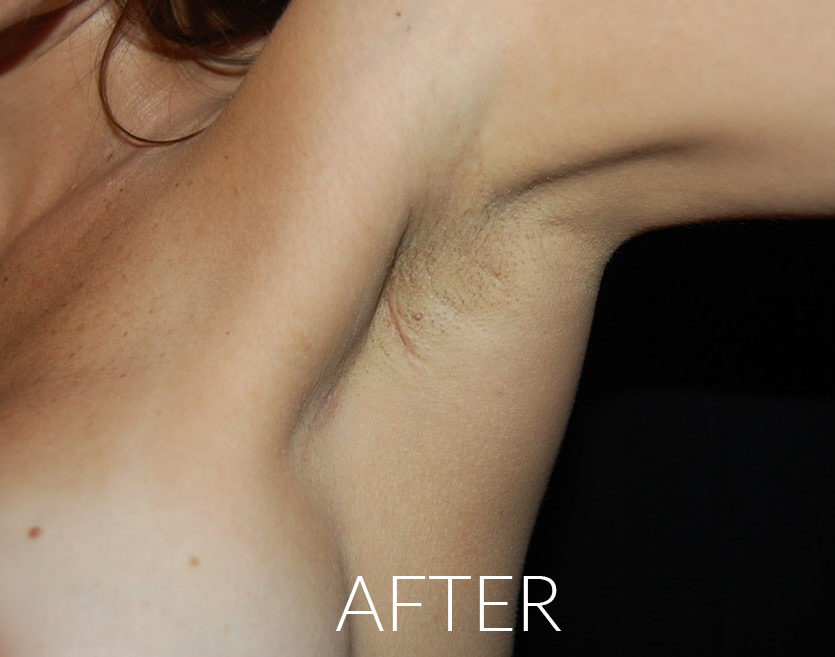 Breast Augmentation Scar