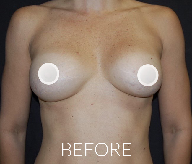 Before Breast Augmentation Surgery