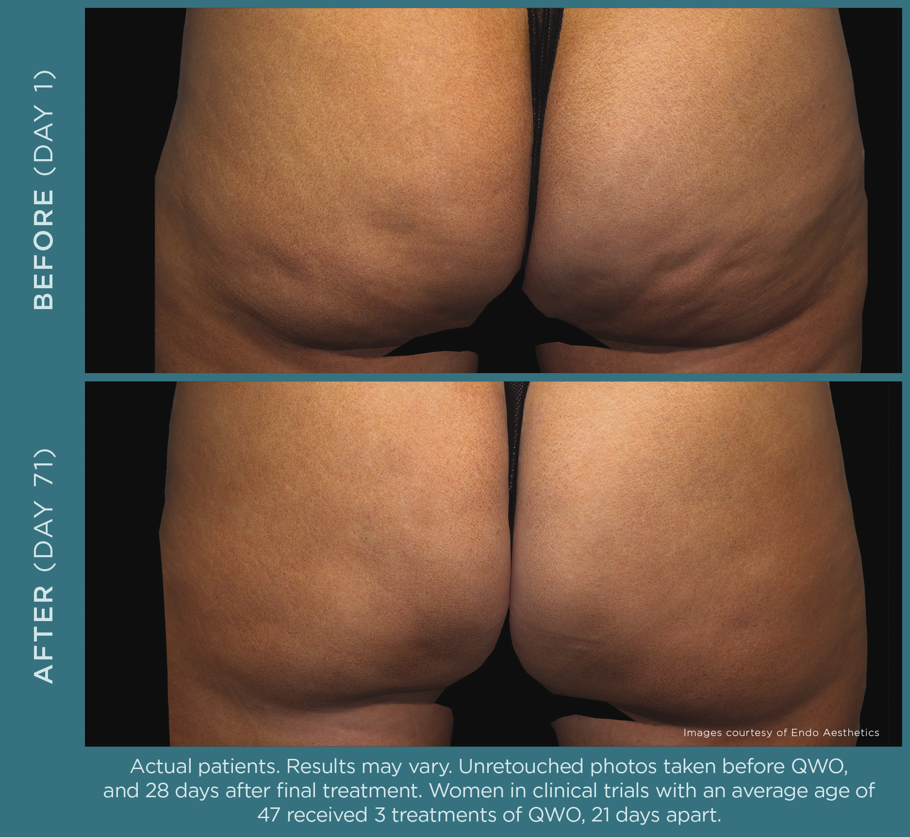 before and after qwo cellulite treatment on buttocks with much less cellulite after treatment