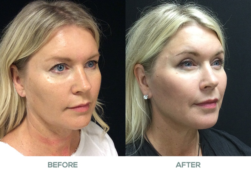 4613 blepharoplasty necklift featured image service page