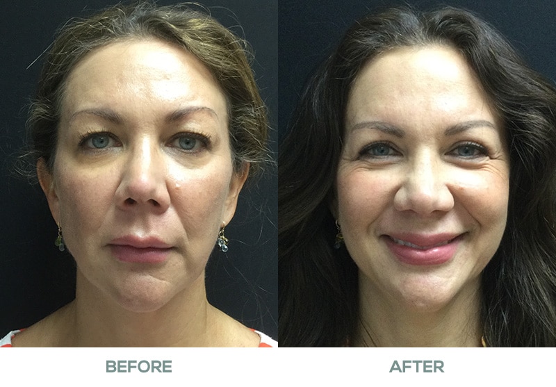 blepharoplasty featured image service page c2