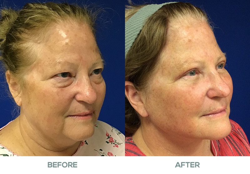 blepharoplasty necklift featured image service page