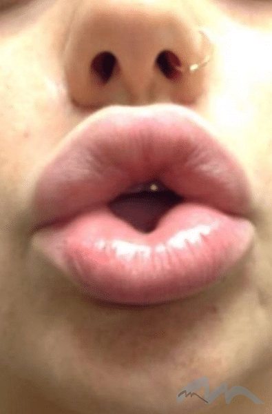 Lip Surgery