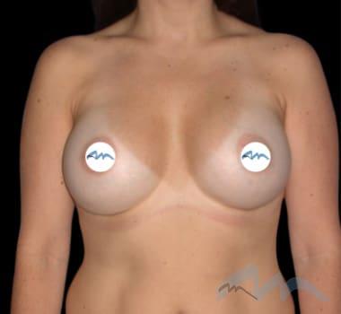 Breast Augmentation Dr Polo 1 a1