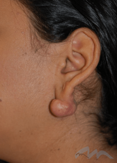Keloid Removal Scar Revision Dr Polo 1b