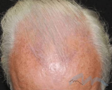 NeoGraft Hair Restoration Dr Polo 1 a1