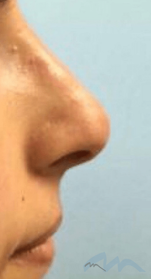 Liquid Rhinoplasty