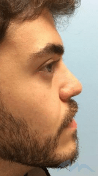 Liquid Rhinoplasty