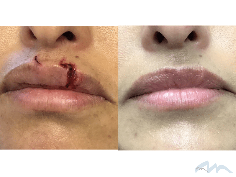 Lip Surgery after a dog bit Dr. Wolf 1 2