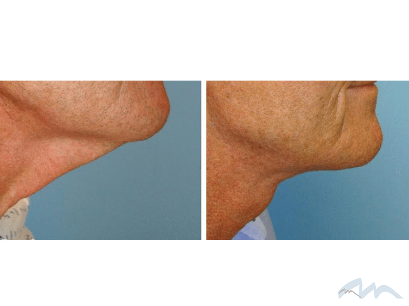 Dr. Wolf's Neck Lift Patients Miami Plastic Surgery