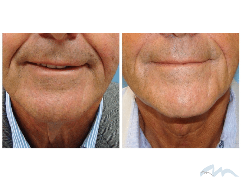 Dr. Wolf's Neck Lift Patients Miami Plastic Surgery