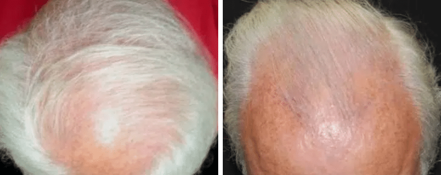 hair restoration before and after photos