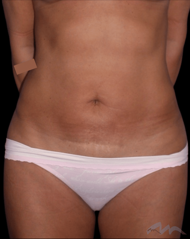 Dr Polo Liposuction