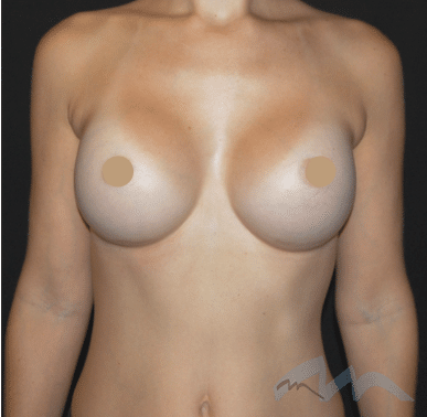 Breast Augmentation