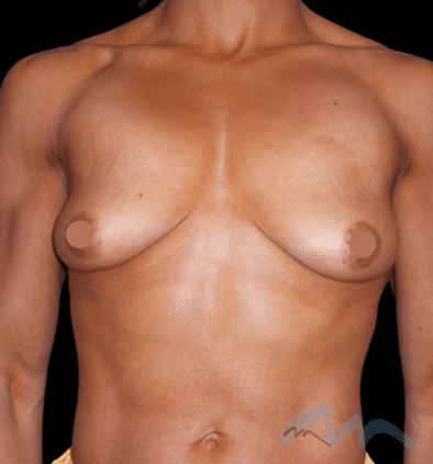 Breast Augmentation