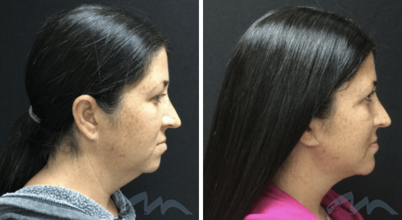 Before & After Image Of A Woman With Chin Augmentation